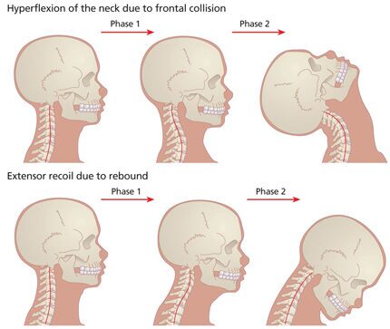 diagram of how whiplash occurs and the different flexion of the neck