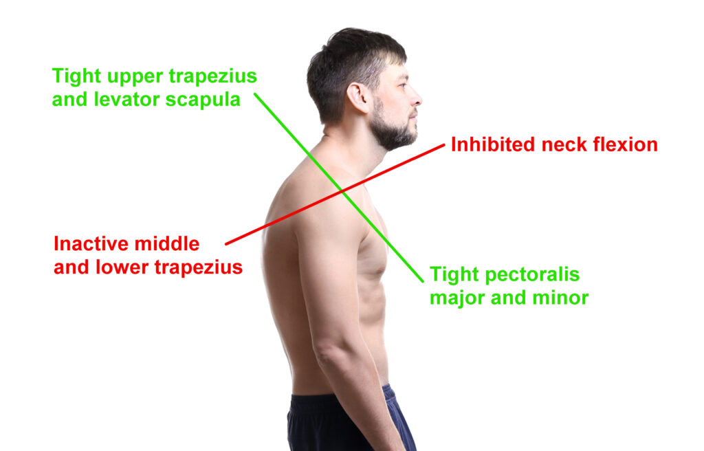 Diagram of a man with upper crossed syndrome diagram