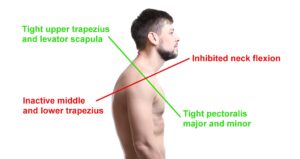 Diagram of man with upper crossed syndrome